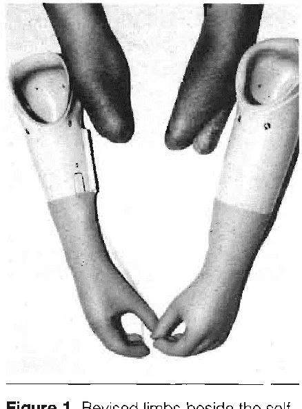 Prosthesis For Bilateral Krukenberg Amputation