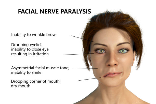 Facial Nerve Palsy: Cause, Symptoms, Diagnosis, Treatment, Exercise