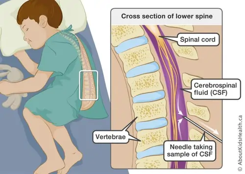 Lumbar puncture