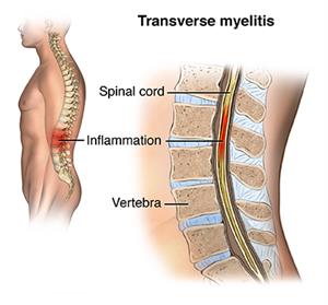 Acute transverse myelitis: Cause, Symptoms, Treatment, Exercise
