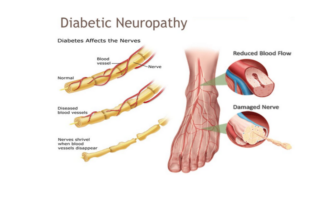 Diabetic-neuropathy