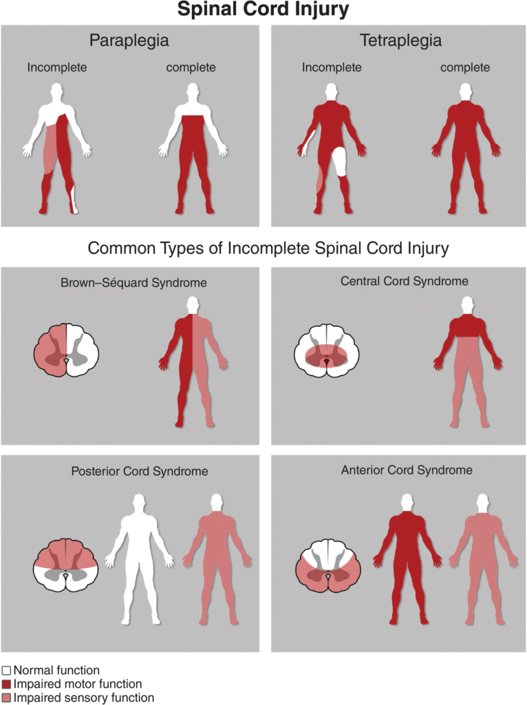 Types and Syndromes of SCI(Spinal cord injury)