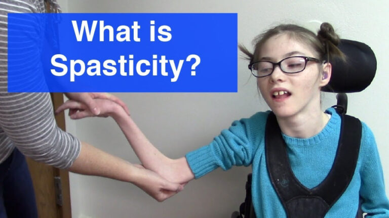 Spasticity and Physiotherapy Treatment:-