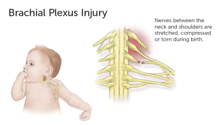 Brachial Plexus injury