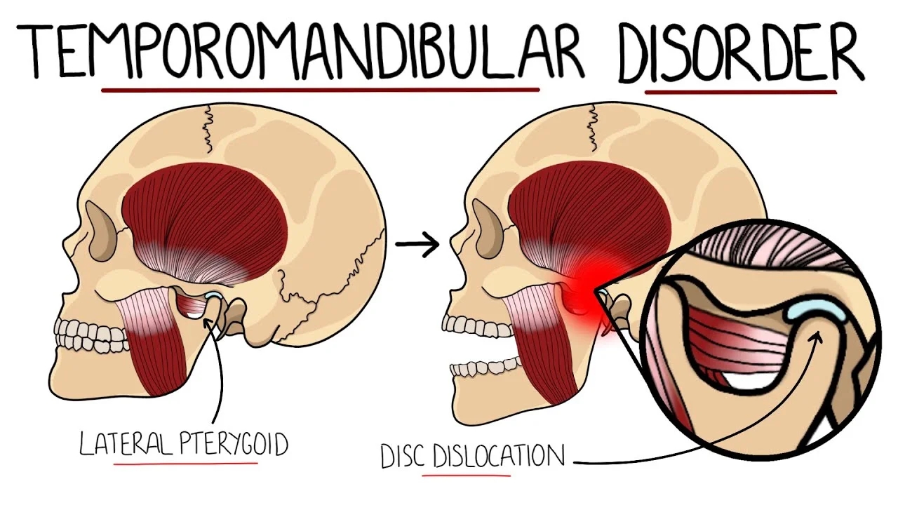 temporomandibular joint (tmj) disorders