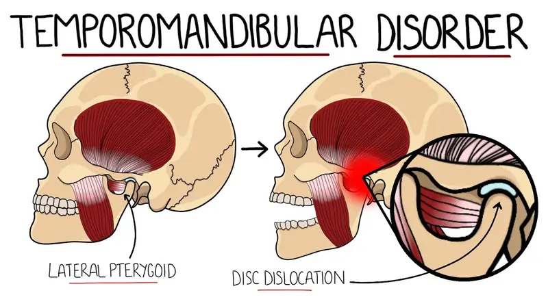 Temporomandibular Joint (TMJ) disorders