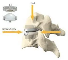 Artificial disc replacement