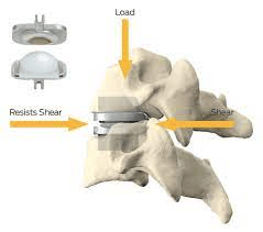 Artificial disc replacement surgery for cervical degenerative disc disease