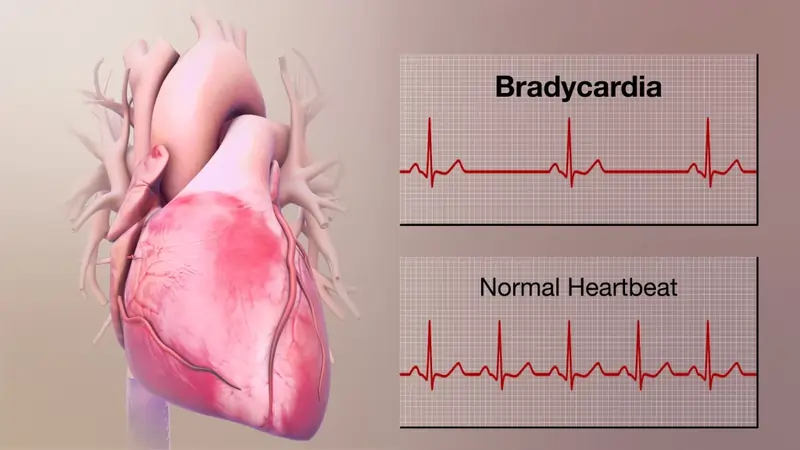 Bradycardia