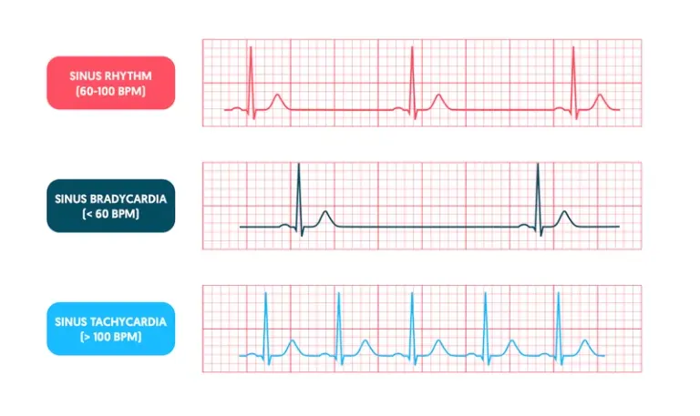 Sinus-bradycardia