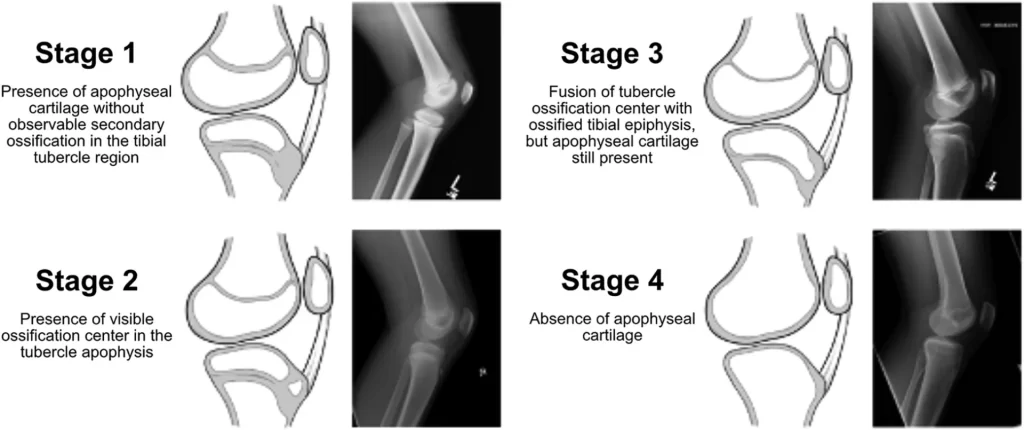 Stages of the tibial tuberosity