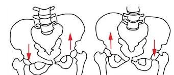 Left vs Right pelvic tilt