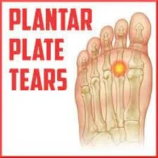 Plantar Plate Tear