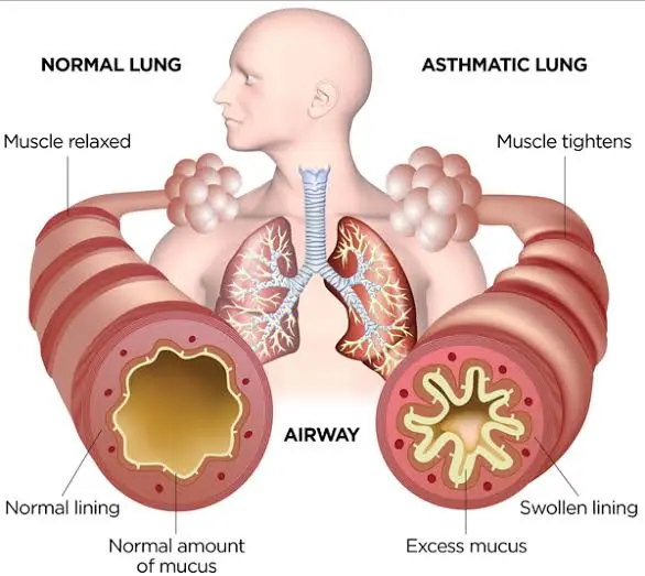 Home treatment for asthma