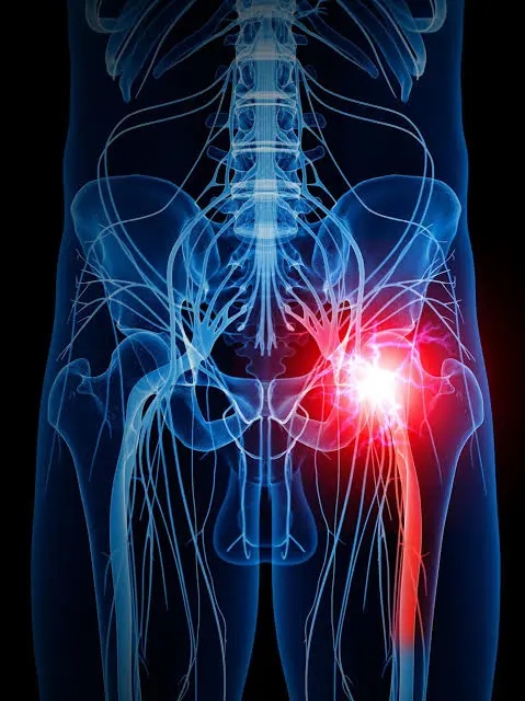 Home treatment of sciatic pain