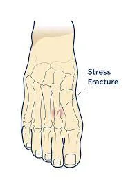 Stress Fracture in The Foot