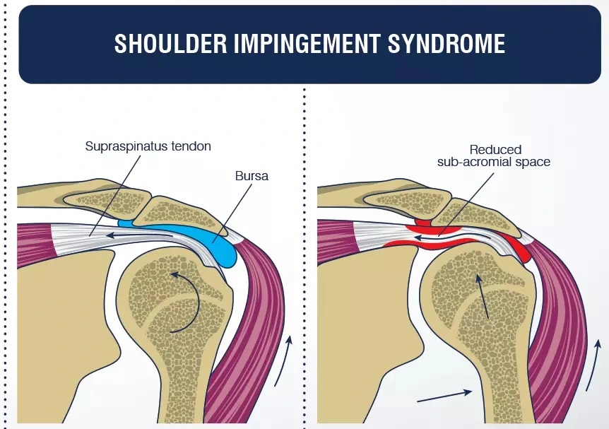 Shoulder-Impingement