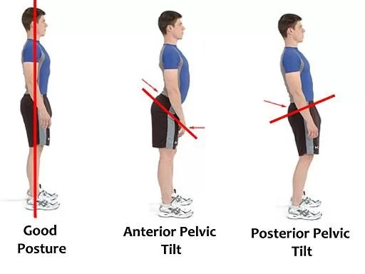 Pelvic Tilt: Causes, Symptoms & Exercises