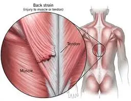 pulled back muscle