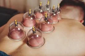What does Cupping Treatment Do?
