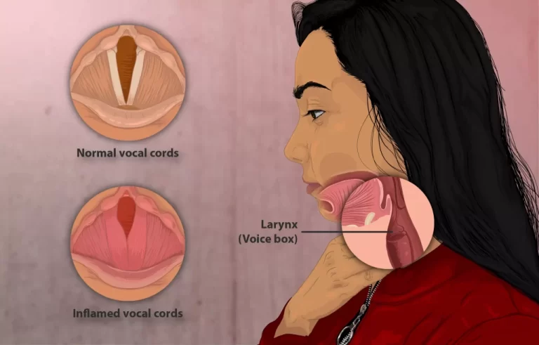 Dysphonia (Hoarse voice): When Your Voice Takes a Wrong Turn