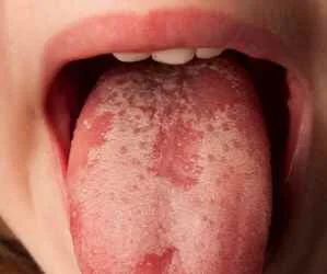 Sore Back of Tongue: Causes, Symptoms, and Relief Strategies