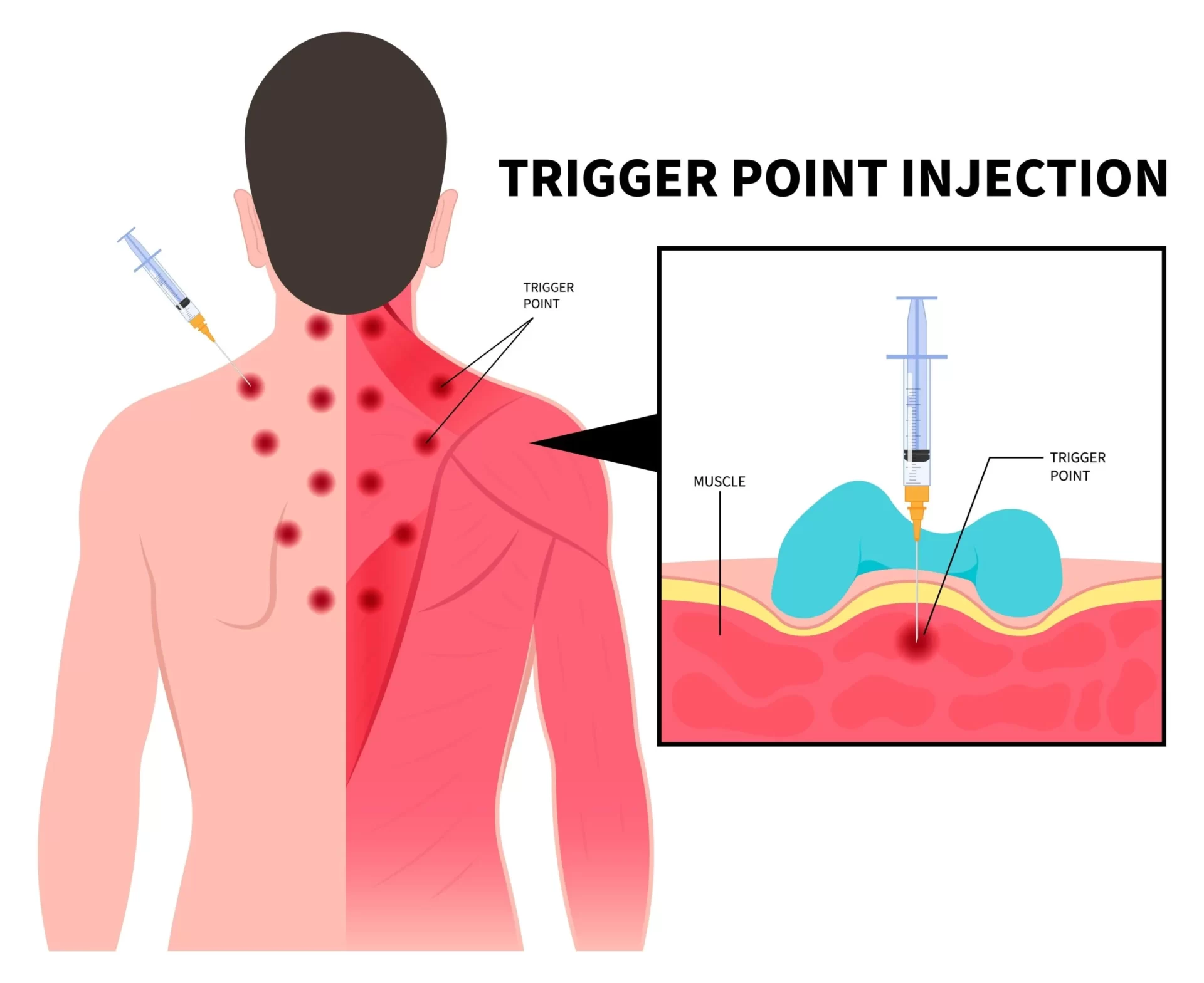 Trigger Point injections