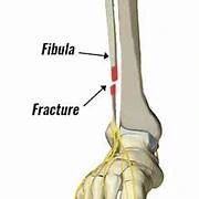 Fibula Fracture
