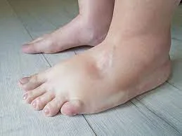 To get rid of foot oedema