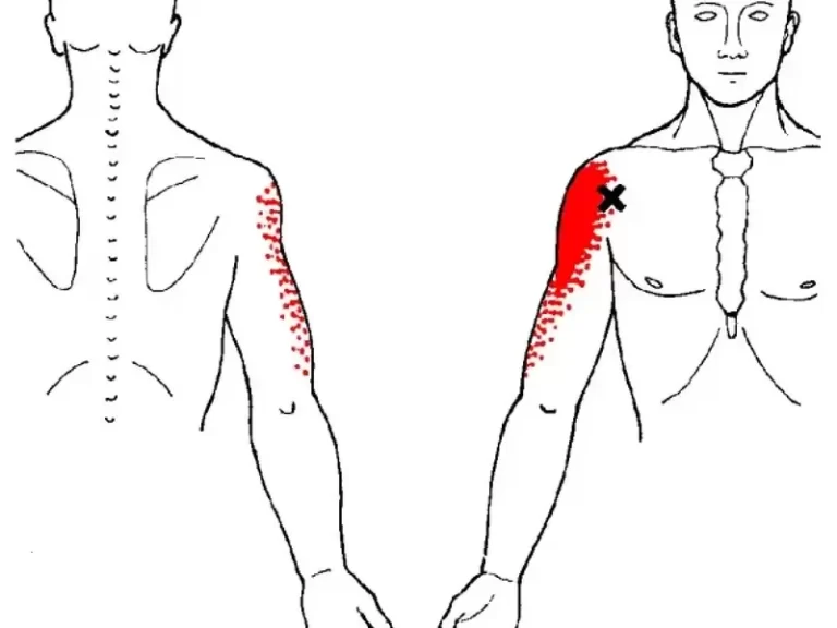 Deltoid Muscle Pain