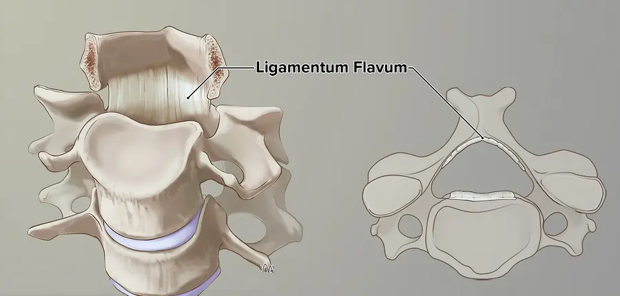 Ligamentum flavum hypertrophy