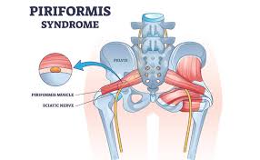 Piriformis Syndrome