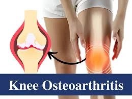 Knee Osteoarthritis