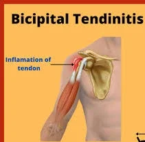 Bicipital Tendinitis