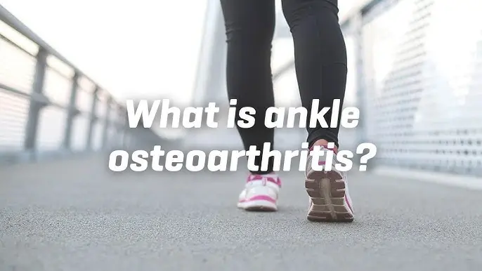 What Is Ankle Osteoarthritis