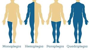 Monoplegia